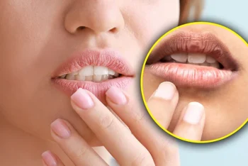 ঠোঁট ফাটলে কী করবেন